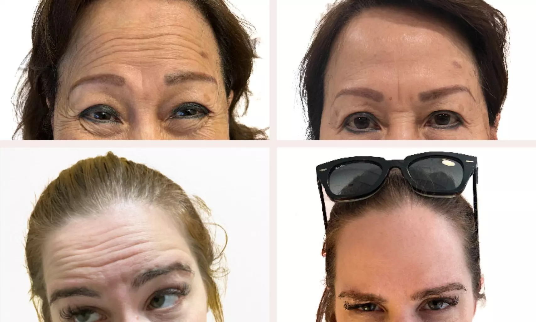 Revitalize Your Look with 30 or 40 Units of Botox or Xeomin