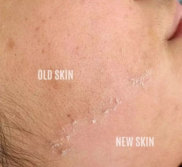 Up to 19% Off on Dermaplaning at Aesthetics Care Med Spa