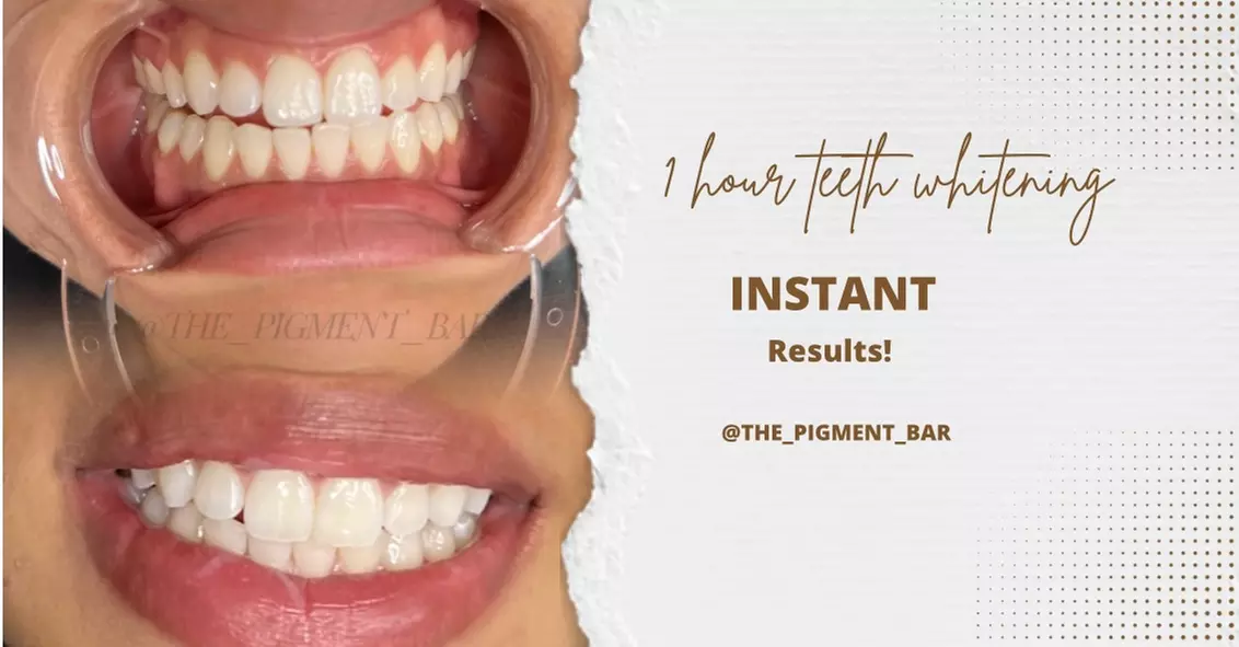 Enhance Your Smile with The Pigment Bar's 1 Hour Teeth Whitening, Up to 34% Off - Primary Image