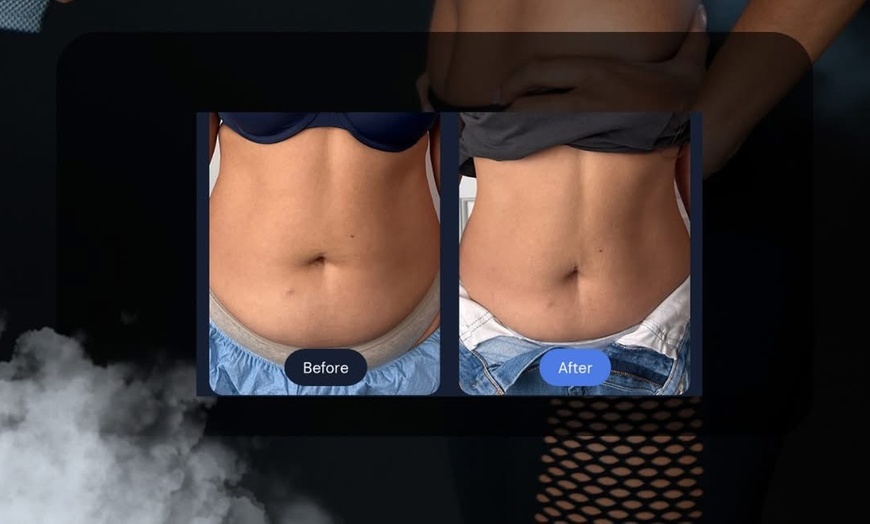 Image 7: Cryoslimming for Stubborn Abdominal Fat: No Surgery, No Downtime