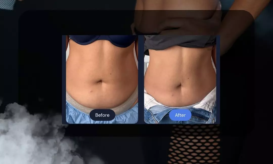 Cryoslimming for Stubborn Abdominal Fat: No Surgery, No Downtime at Lana Rosh Studio (Up to 45% Off) - Second Medium