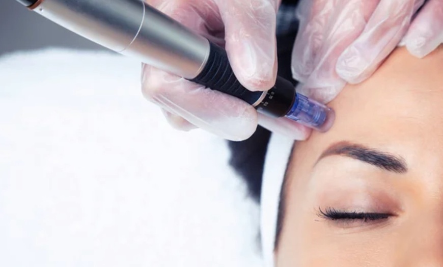 Image 1: Transform Your Look With One or Two Micro-Needling Treatments