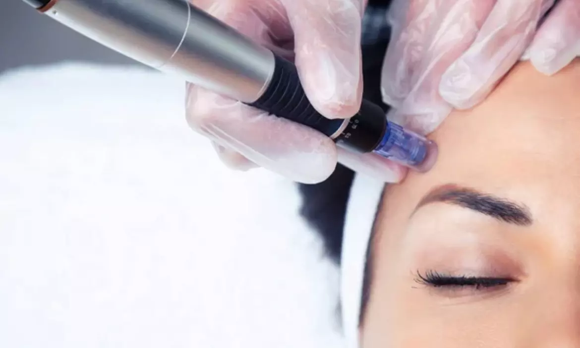 Transform Your Look With One or Two Micro-Needling Treatments