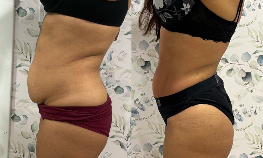Image 3: Up to 69% Off on Cavitation at Soleil med spa