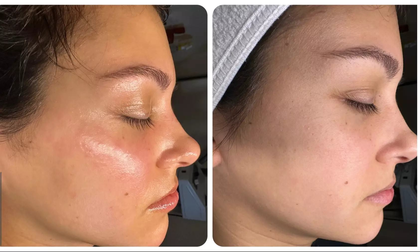 Up to 61% Off on Chemical Peel at Flawless Beauty by Devon - Primary Image