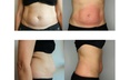 Up to 72% Off on Fat Reduction - Non-Branded at The Covery Fruitville - Second Medium