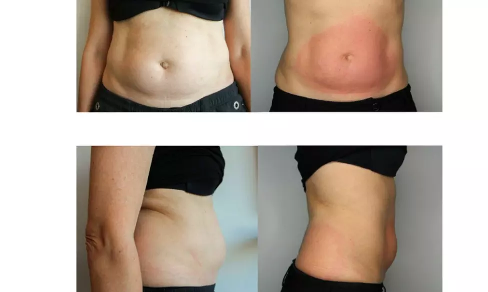 Up to 75% Off on Fat Reduction - Non-Branded at The Covery Fruitville