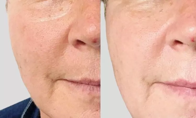 Up to 60% Off on Cryotherapy at UK Aesthetics Lounge