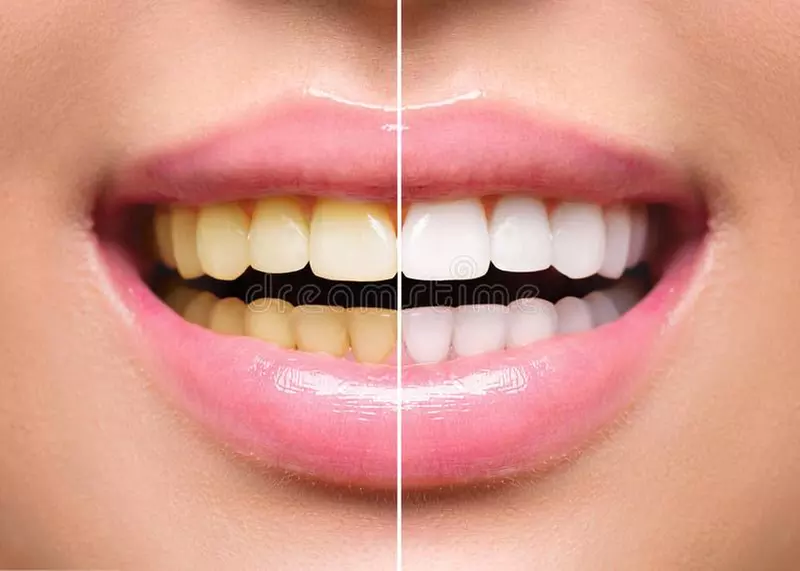 Experience Smile Fairy Spa's teeth whitening with various options and up to 50% off - Primary Image