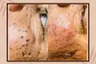 Skin tag removal Up to 34% Off at Regains Beauty & Aesthetics - Image 5