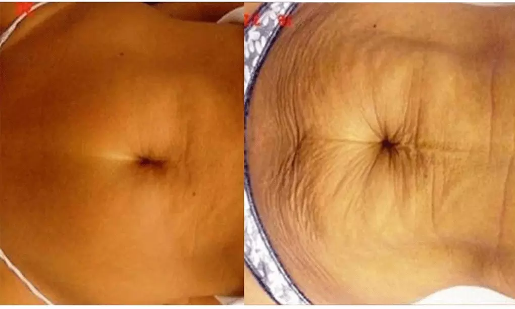 Ultrasonic Body Sculpting Sessions for a Sleeker You