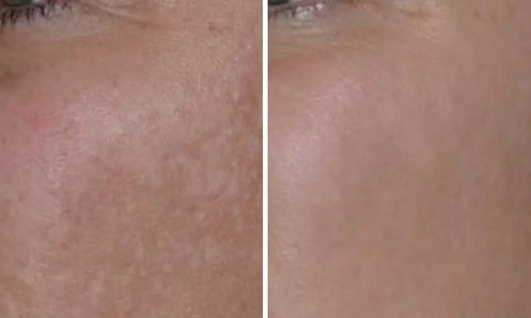 Up to 20% Off on Chemical Peel at Mimosa Spa