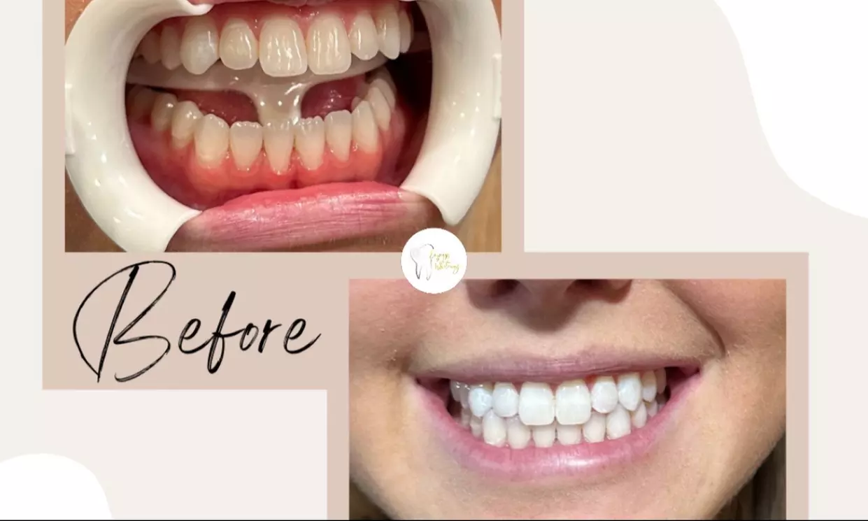 Up to 10% Off on Teeth Whitening at Express Whitening service - Primary Image
