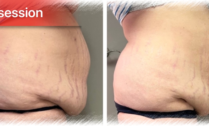 Image 3: Integusculpt RF Skin Tightening & Cavitation Treatment