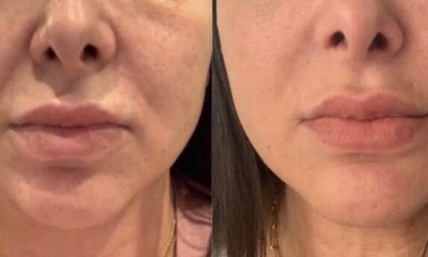 Image 1: Non-Surgical Face, Neck & Stomach Treatment with HIFU Technology 