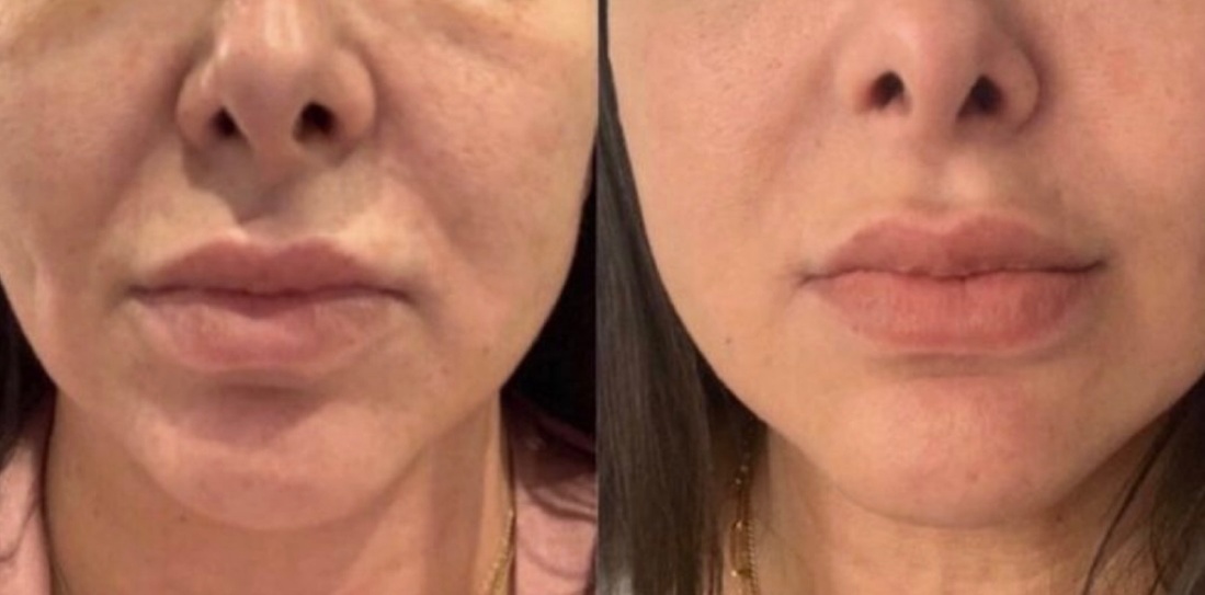 Non-Surgical Face, Neck & Stomach Treatment with HIFU Technology 