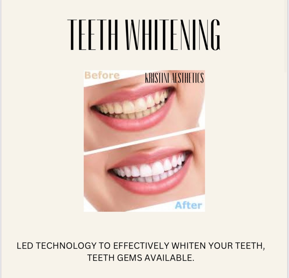 Teeth Whitening Treatment: Flash a Brighter Smile Instantly