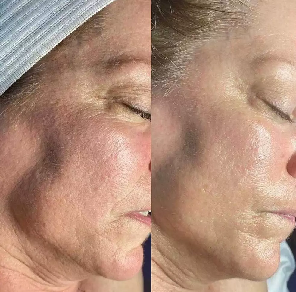 Up to 55% Off on  at Glow Derma Aesthetics - Primary Image