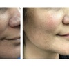 Image 1: Laser Skin Rejuvenation for Face, Neck, or Hands