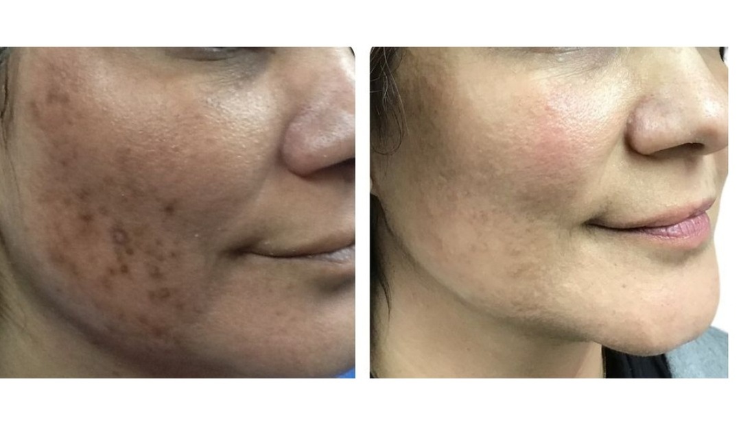 Laser Skin Rejuvenation for Face, Neck, or Hands