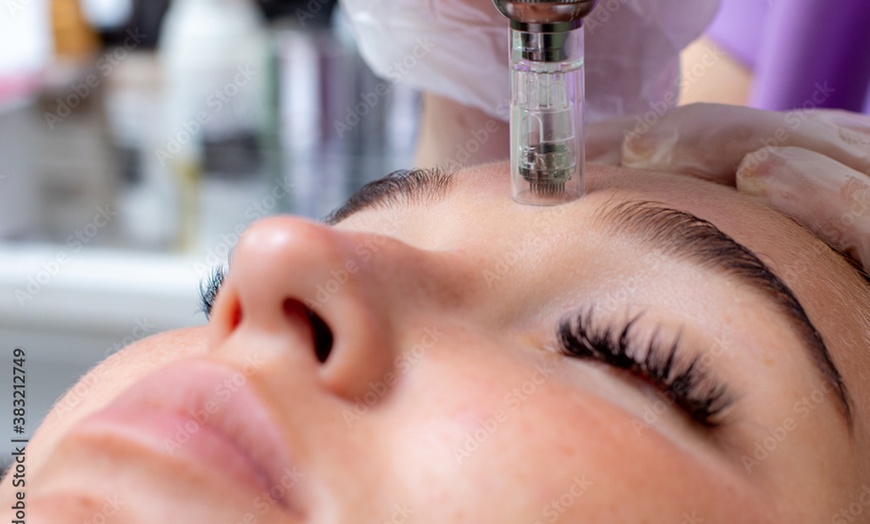 Image 1: Up to 40% Off on Micro-Needling at FARHAM AESTHETIC CLINIC