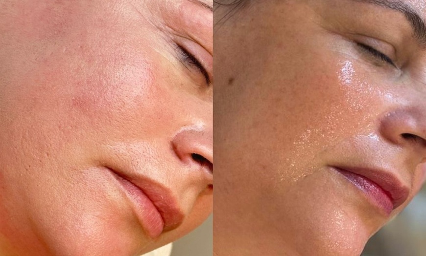 Image 3: 50% Rabatt auf Gesichtsbehandlung bei Lineva Aesthetics