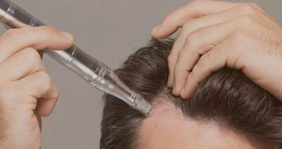 Discover Angel M. Brant's Microneedling Hair Restoration with up to 40% off sessions for hair regrowth - Primary Image