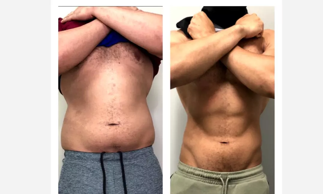 Up to 75% Off on Fat Reduction - Non-Branded at The Covery Fruitville