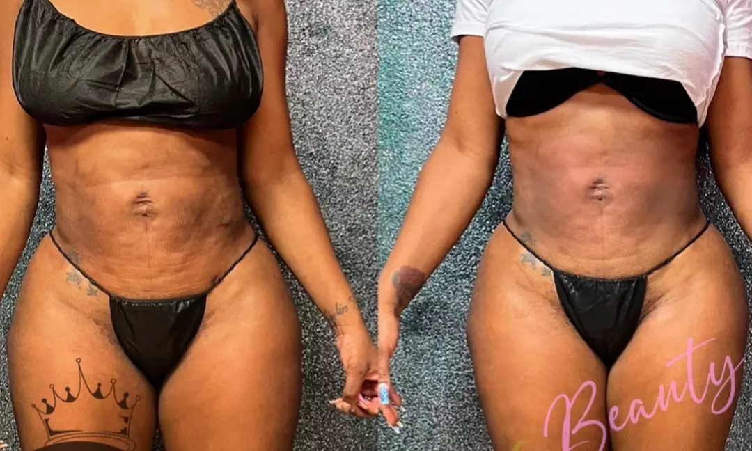 Transform Your Body with 3 or 6 Cavitation Treatments