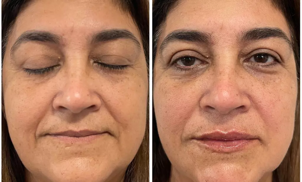 Unleash Your Glow: Transform Wrinkles with Dysport Magic!