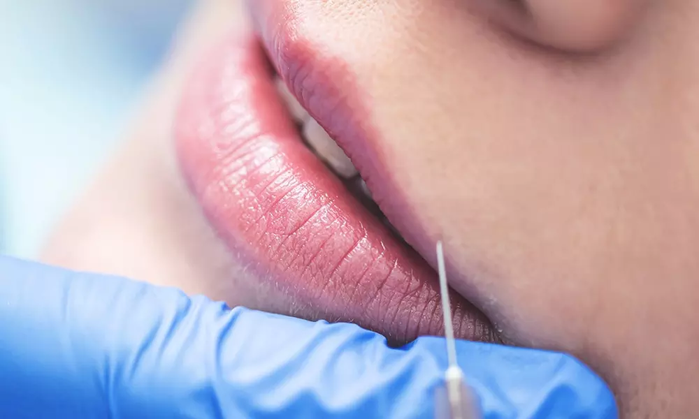 Up to 45% Off on Lip Enhancement at Bloom Health - Primary Image