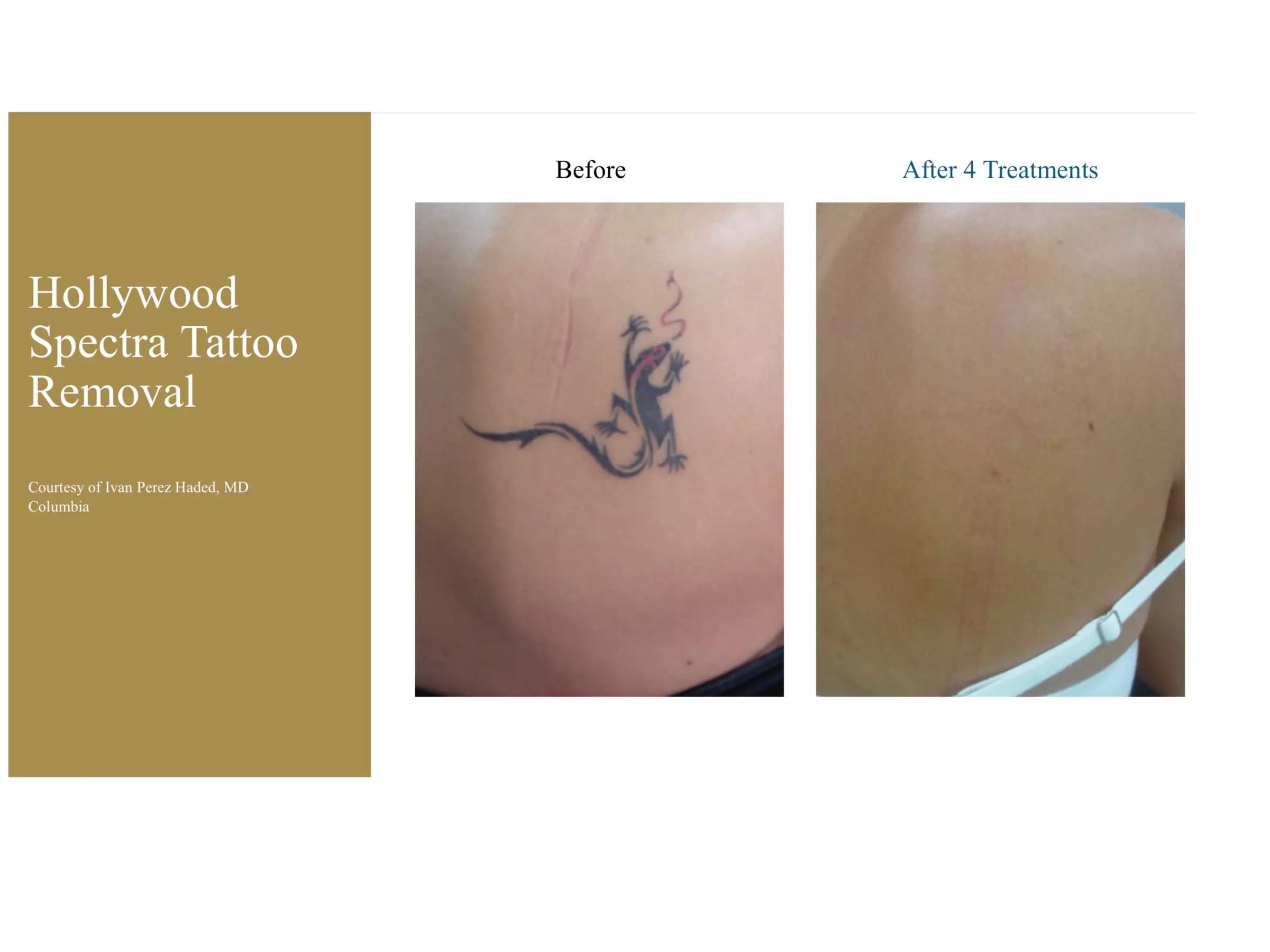 Up to 60% Off on Tattoo - Temporary at Surry Hills Laser & Cosmetic