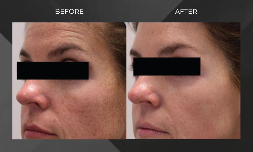 Image 2: Revitalize with MORPHEUS 8/ Sylfirm X Face Skin Tightening Treatment