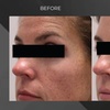 Image 2: Revitalize with MORPHEUS 8/ Sylfirm X Face Skin Tightening Treatment