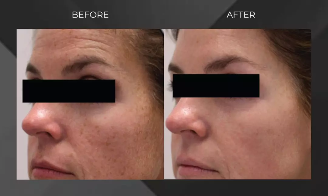 Revitalize with MORPHEUS 8/ Sylfirm X Face Skin Tightening Treatment at Total Body Aesthetics  30% Off  - Second Medium