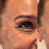 Image 2: Refresh Your Appearance with 20, 40, or 60 Units of Botox