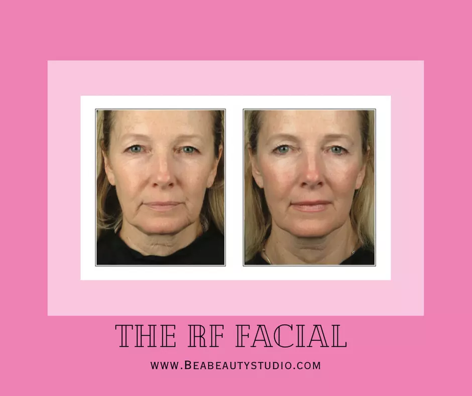 Up to 60% Off on Radio Frequency Anti-Aging Facials at Bea Beauty by Lillie - Second Medium