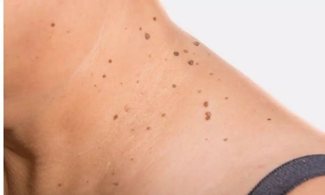 Up to 48% Off on Skin Tag / Growth Removal at Tru U Esthetix - Primary Image
