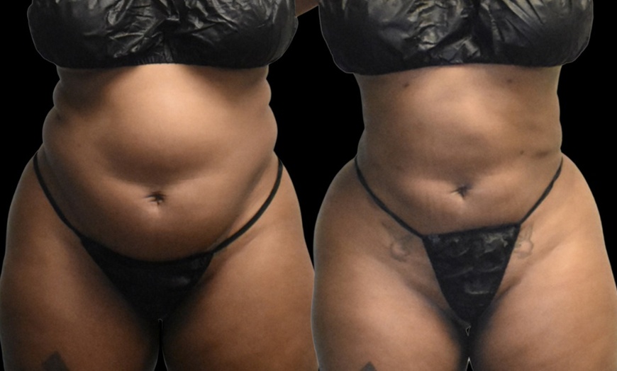 Image 4: Up to 67% Off on Cavitation at Atlanta Body Sculpt