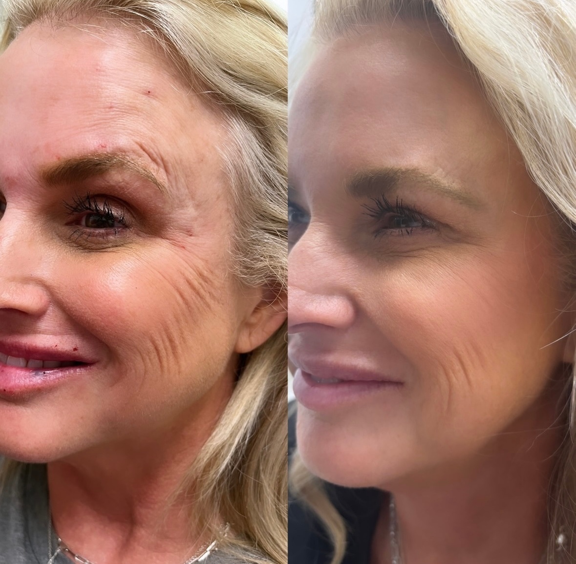 Up to 38% Off on Botox Injections Branded at Biorejuvenate