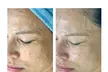 Glow + Sculpt: The Ultimate Hydraglow Microdermabrasion at Rise Skin Spa (Up to 45% Off ) - Second Medium