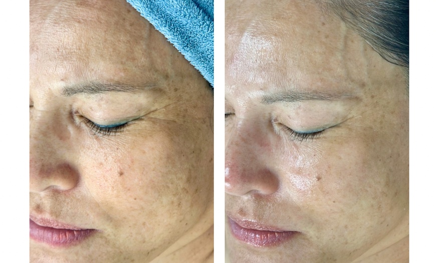 Image 3: Glow + Sculpt: The Ultimate Hydraglow Microdermabrasion