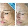 Image 3: Up to 40% Off  Hydraglow Microdermabrasion at Rise Skin Spa