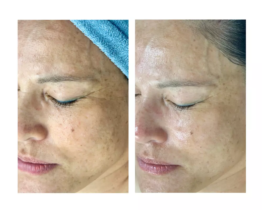 Glow + Sculpt: The Ultimate Hydraglow Microdermabrasion