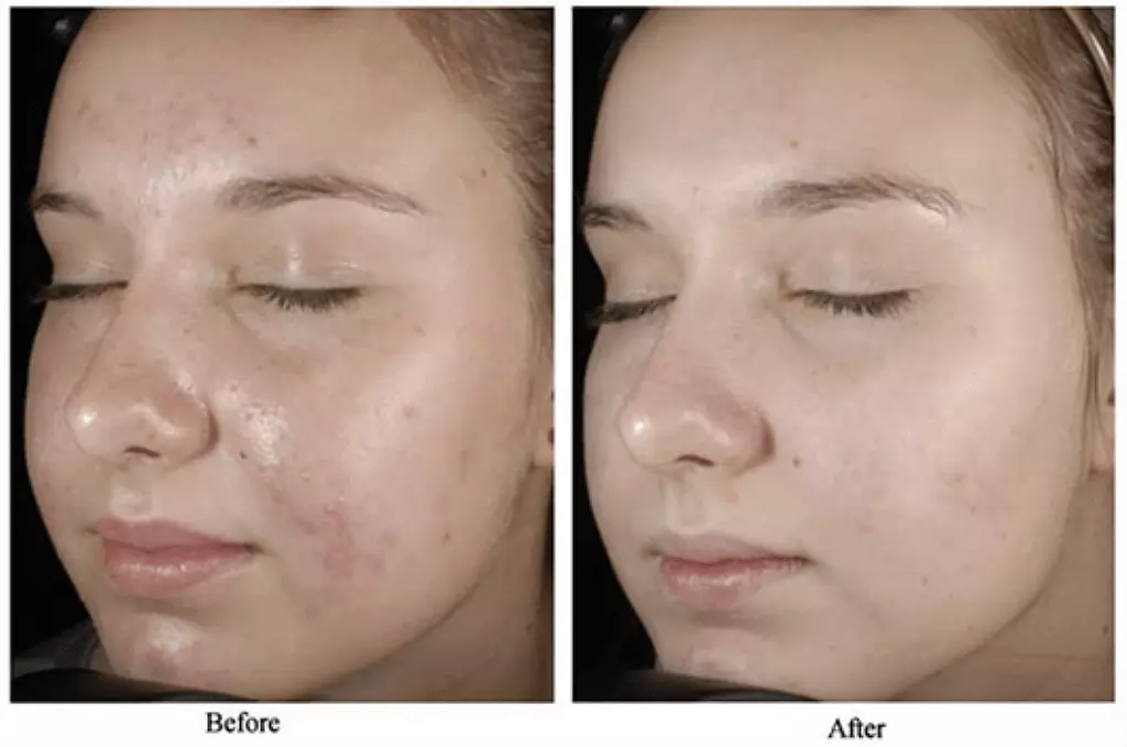 Up to 30% Off on Chemical Peel at DeepHaven Rejuvenation - Primary Image