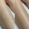 Image 3: Up to 70% Off on Laser Hair Removal at Skin & Laser Aesthetics