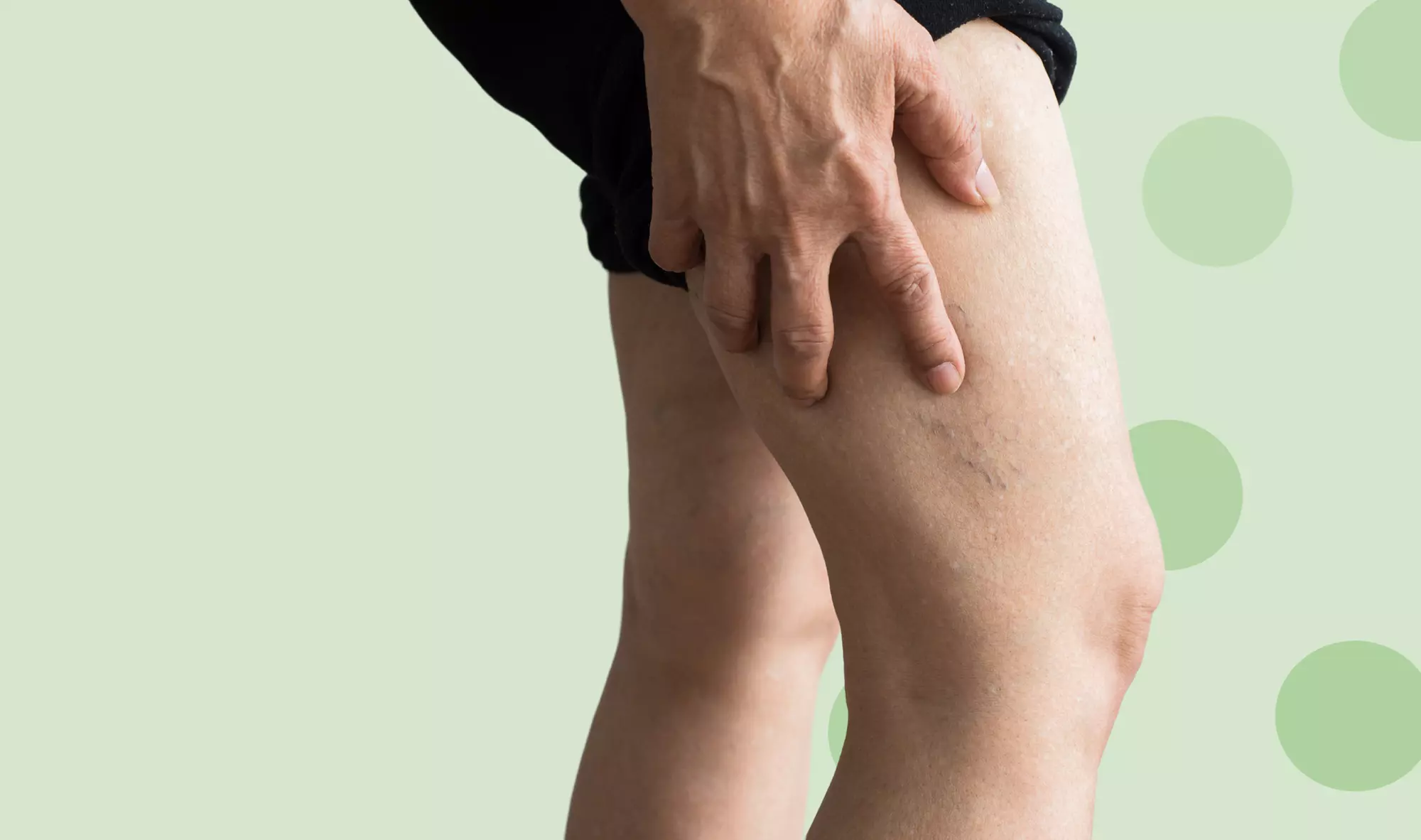 Spider Vein Removal at Med Spa Mount Dora (Up to 67% Off) - Primary Image