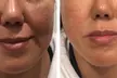 Smooth Out Fine Lines with 20 Units of Botox or 0.5 or 1 ml Syringe of Juvéderm (Up to 62% Off) - Second Medium
