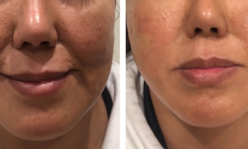 Image 4: Smooth Out Fine Lines with Botox or Juvéderm (Up to 62% Off)