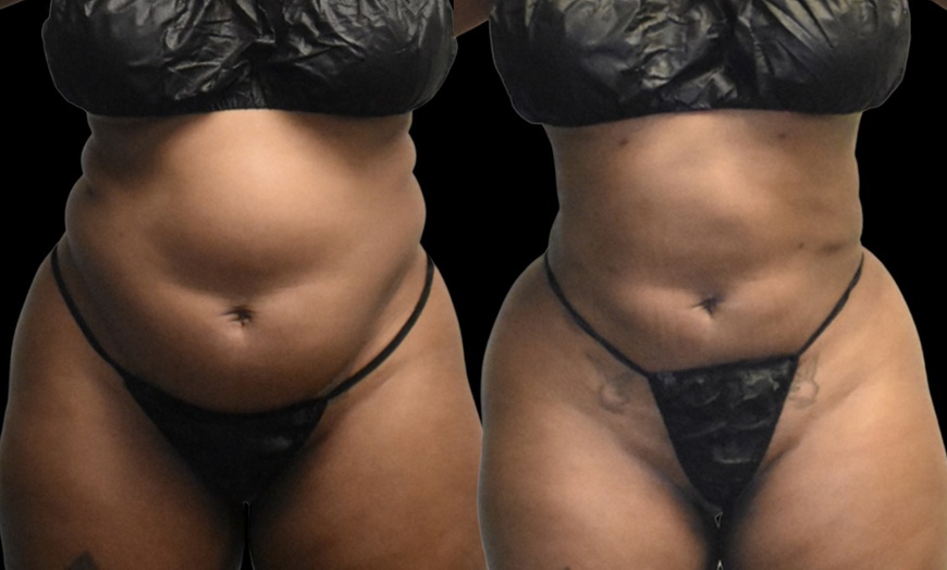 Image 4: Up to 79% Off on Lipo - Non-Invasive Laser-iLipo at Atlanta Body Sculpt